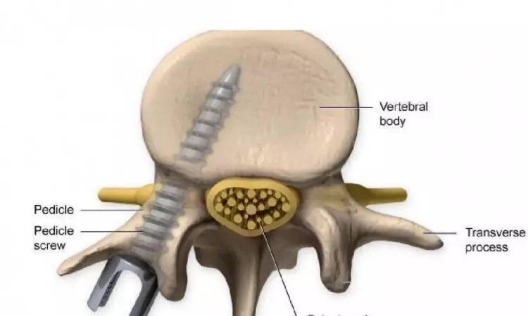 پیچ های ارتوپدی پدیکل چگونه در جراحی ستون فقرات استفاده می کنند
